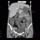 Crohn's disease, terminal ileum, stenosis, CT enterography: CT - Computed tomography
